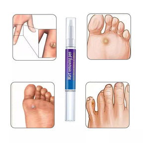 Wart Remover Pen For Skin