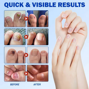 Fungal Nail Repair Patches